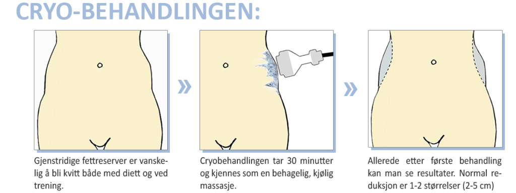 Cryobehandling 1200px